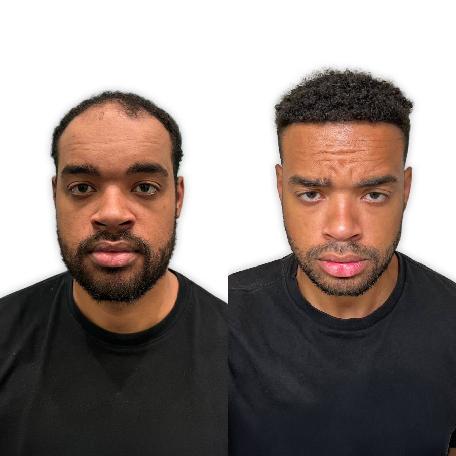 Antes e depois — Lucas, transplante DHI