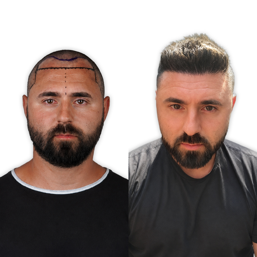 Antes e depois — Rafael, Sem Raspar