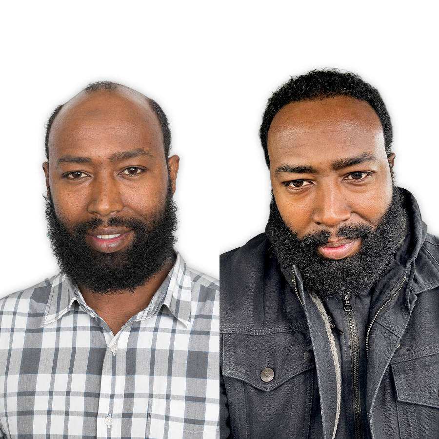 Antes e depois — Marcos, transplante DHI