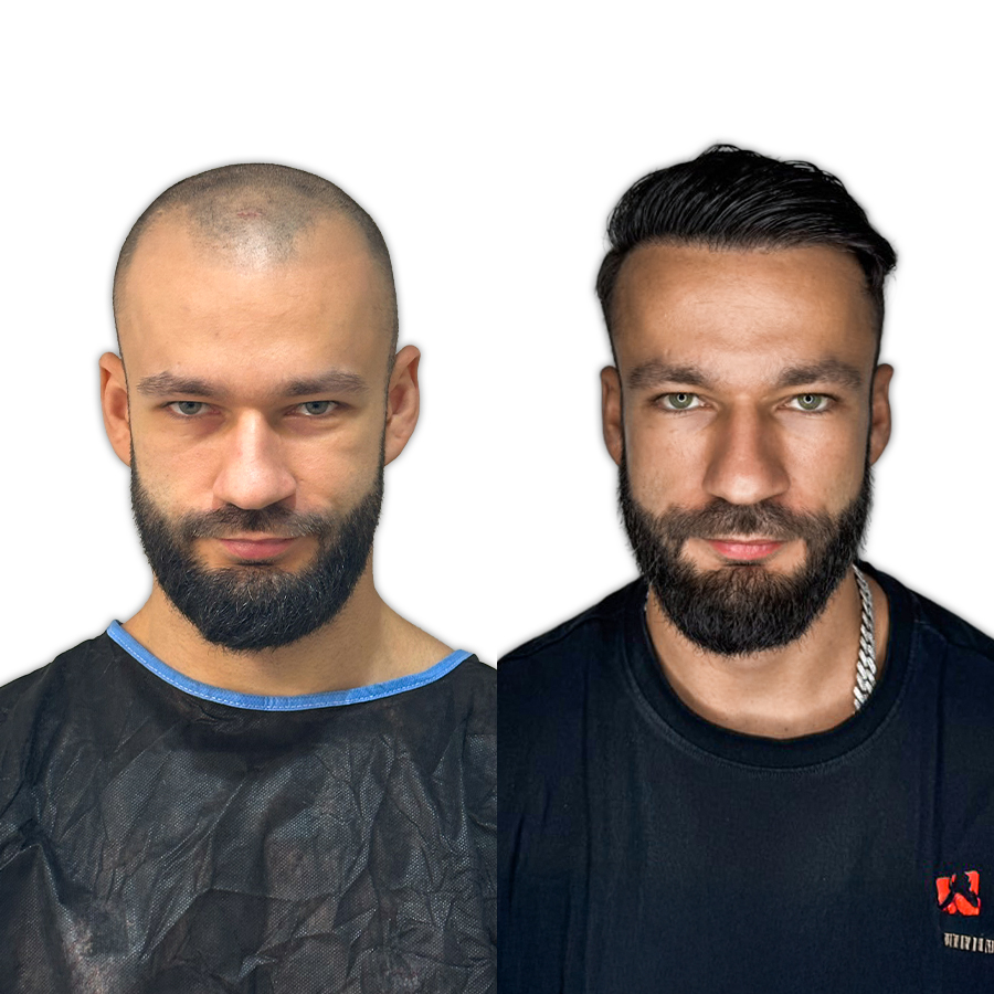 Antes e depois — Pedro, Sem Raspar